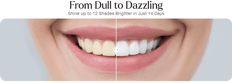 Nubeam Supersmile Teeth Whitening After Before use